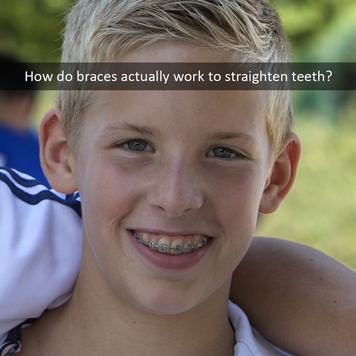 how braces work 2022 700 Scripps Poway Orthodontics